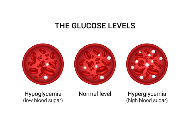Ilustración vectorial de los niveles de glucosa en sangre. Hipoglucemia. Hiperglucemia. - Vector, imagen