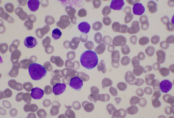 Blastocitos moderados de glóbulos blancos en el frotis de la sangre.Leucemia imagen de la sangre. - Foto, Imagen