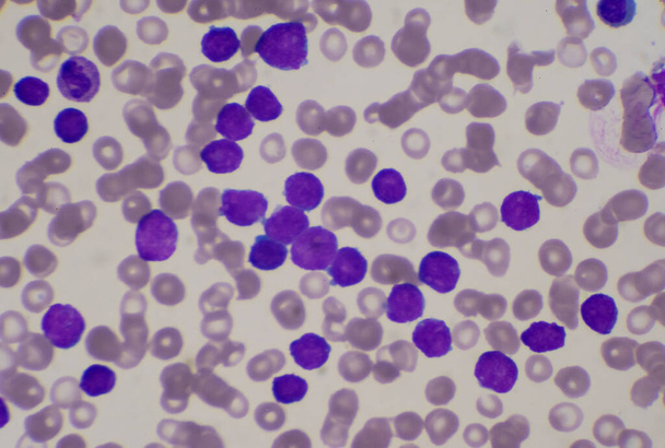 血液中の白血球の中程度の芽細胞。白血病の血液像. - 写真・画像