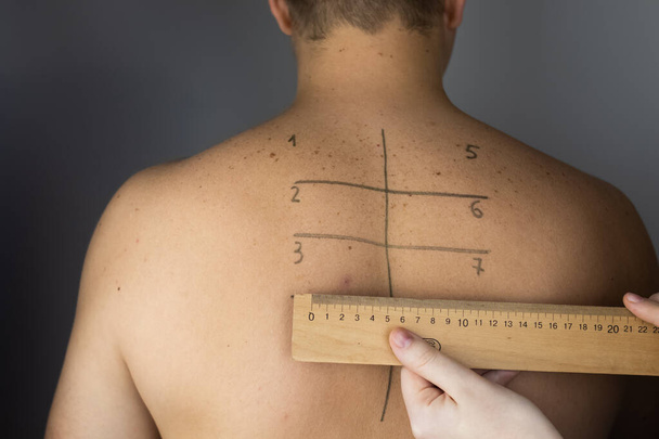 Allergist or dermatologist examines red spots on a mans face. The male suffers from a rash, hives and itching. Food Allergy, Insect Bite, Measles or Chicken Pox. Measuring rash with a ruler - Photo, Image