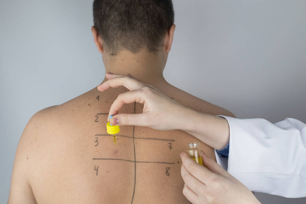 An allergist in the laboratory conducts an allergy prick-test. Skin test for household, food, epidermal allergic reactions. The test is performed on the patient's back - Foto, Imagen