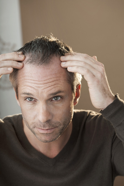 Alopecia - Foto, afbeelding