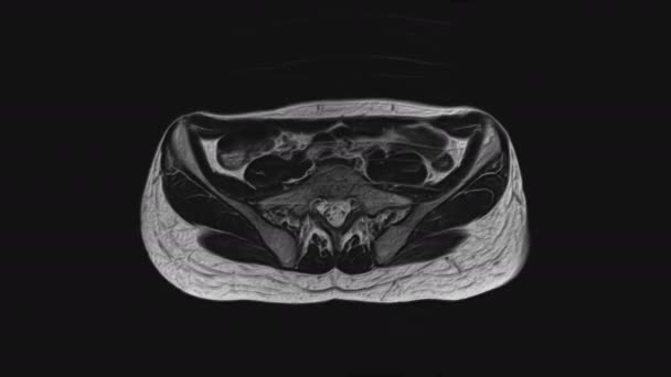 IRM volumineuse des organes pelviens féminins, cavité abdominale, tractus gastro-intestinal et vessie - Séquence, vidéo