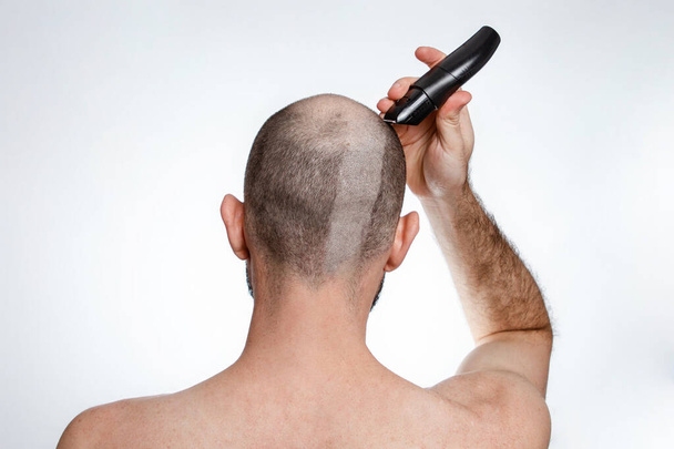 Il concetto di calvizie e alopecia. Un uomo tiene un tagliacapelli e si rasa i capelli sopra la testa. La vista dal retro. Copia spazio. - Foto, immagini
