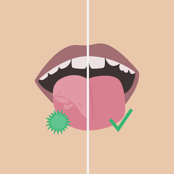 Karşılaştırma. Dilinde bakteri ve sağlıklı bir dille beyaz noktalar var.. - Vektör, Görsel