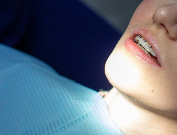 歯にブレースをつけた女性が歯医者さんの椅子に腰掛けている。上歯と下歯にブレースのアーチを設置する手順中に。女の子は微笑む。歯科の概念 - 写真・画像