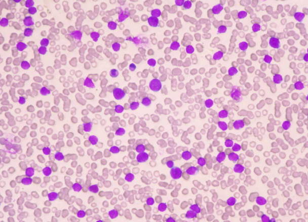 Blastocytes modérés de globules blancs dans le frottis sanguin.. - Photo, image