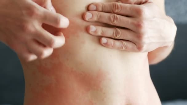 Ihminen raapii niskaansa punaista ihottumaa. Allergiat ja ihosairaudet - Materiaali, video