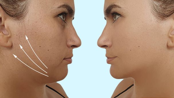 barbilla doble de mujer antes y después del tratamiento - Foto, Imagen