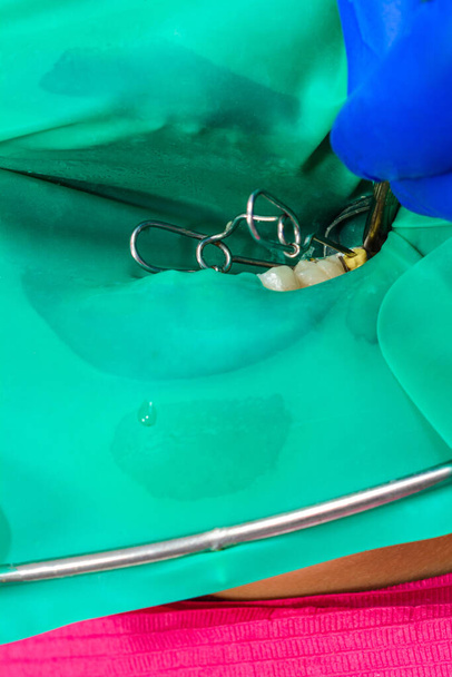 Un paciente en una cita con el dentista, un médico utiliza una presa de goma para tratar los dientes, desinfecta un diente para rellenar. 2020 - Foto, Imagen