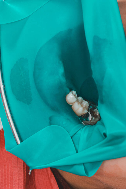 лечение жевательного зуба, стоматолог поставил резиновую плотину, использует стерильные инструменты, использует современные технологии. 2020 - Фото, изображение