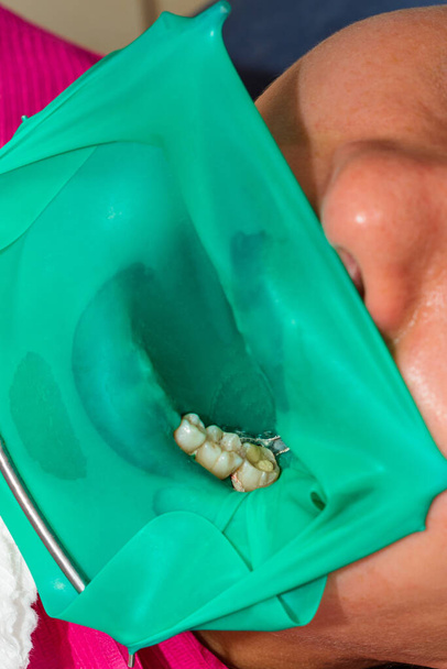 a rágófog kezelése, a fogorvos gumi gátat helyezett, steril szerszámokat használ, modern technológiát használ.2020 - Fotó, kép