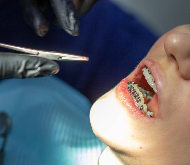 Una mujer con aparatos ortopédicos en los dientes visita a un ortodoncista en una silla dental. durante el procedimiento de instalación del arco de los aparatos ortopédicos en los dientes superior e inferior. El médico examina los dientes. odontología - Foto, Imagen