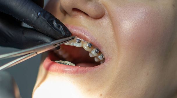 Nainen hammasraudat vierailee oikomishoidon klinikalla, hammastuolissa. menettelyn aikana asennettaessa kaari hammasraudat ylemmän ja alemman hampaat. Hammaslääkärillä on käsineet ja hammasinstrumentit käsissään. Käsite - Valokuva, kuva