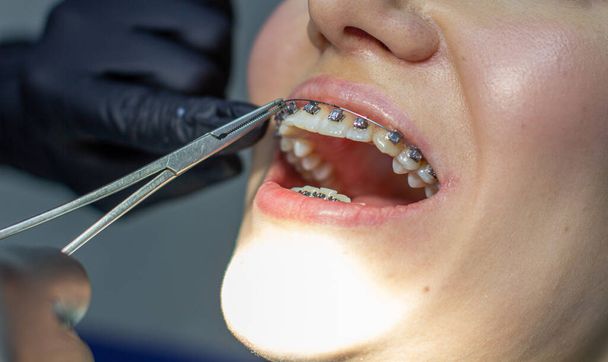 Egy fogszabályzós nő meglátogat egy fogorvost a klinikán, egy fogorvosi székben. a fogszabályozó ívének a felső és alsó fogakra történő felszerelésére irányuló eljárás során. A fogorvos kesztyűt visel, és fogászati eszközök vannak a kezében. A koncepció - Fotó, kép
