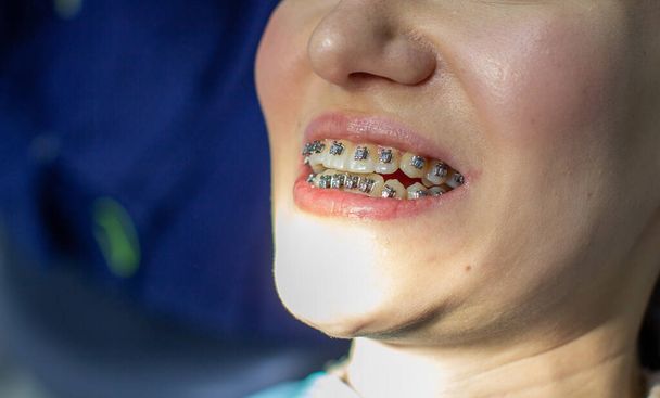 Una donna con l'apparecchio ai denti va a trovare un ortodontista, su una sedia dentale. durante la procedura di installazione dell'arco di bretelle sui denti superiori e inferiori. La ragazza sorride. Il concetto di odontoiatria - Foto, immagini