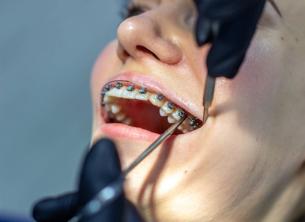 歯のブレースを持つ女性は、歯科椅子で、診療所の歯科矯正医を訪問します。上歯と下歯にブレースのアーチを設置する手順中に。歯医者は手袋をしていて、手に歯科器具を持っている。コンセプト - 写真・画像