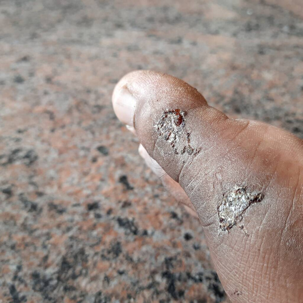 Close-up van twee wonden of letsel aan Indiase man been, voeten - Foto, afbeelding