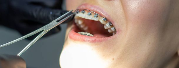 歯のブレースを持つ女性は、歯科椅子で、診療所の歯科矯正医を訪問します。上歯と下歯にブレースのアーチを設置する手順中に。歯医者は手袋をしていて、手に歯科器具を持っている。コンセプト - 写真・画像