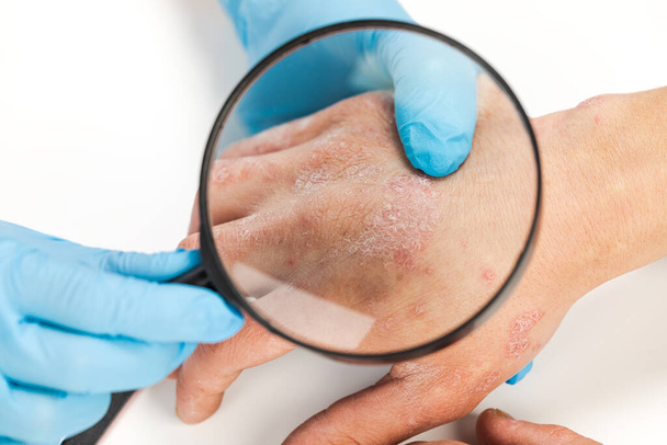Un dermatologo che indossa guanti esamina la pelle di un paziente malato. Esame e diagnosi di malattie della pelle allergie, psoriasi, eczema, dermatite. - Foto, immagini