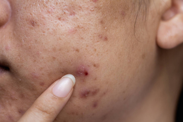 Gros plan peau du visage est l'acné et la cicatrice. - Photo, image