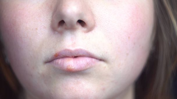 Close-up de herpes doença nos lábios de uma jovem. Mídia. Detalhes da face feminina com os pontos de vírus, conceito de medicina e doenças. - Foto, Imagem