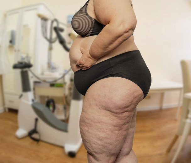 Mulher com obesidade e celulite em uma sala de tratamento com um médico - Foto, Imagem