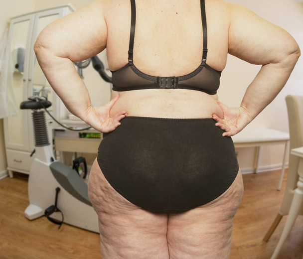 Woman with obesity and cellulite in a treatment room with a doctor - Photo, Image