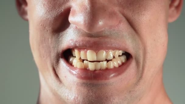 Der Mann zeigt seine gelben schiefen und hervorstehenden Zähne. Malokklusion. Nahaufnahme. - Filmmaterial, Video