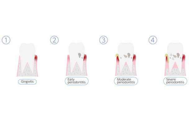 Illustrazione della progressione della malattia parodontale, 4 fasi - Vettoriali, immagini