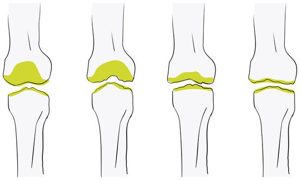 Ilustración vectorial del flujo de osteoartritis de la rodilla es peor - Vector, Imagen