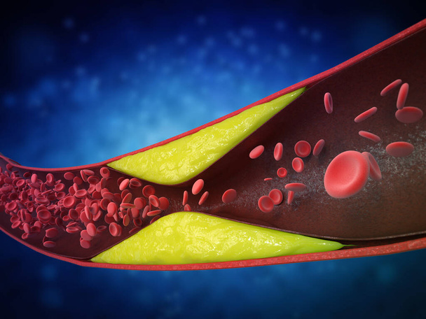 aterosclerosis 3d renderizado con colesterol sangre o placa en los vasos sanguíneos causa de enfermedad arterial coronaria  - Foto, imagen