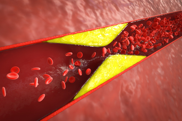 3D-Rendering Arteriosklerose mit Cholesterinblut oder Plaque in Gefäßen Ursache der koronaren Herzkrankheit  - Foto, Bild