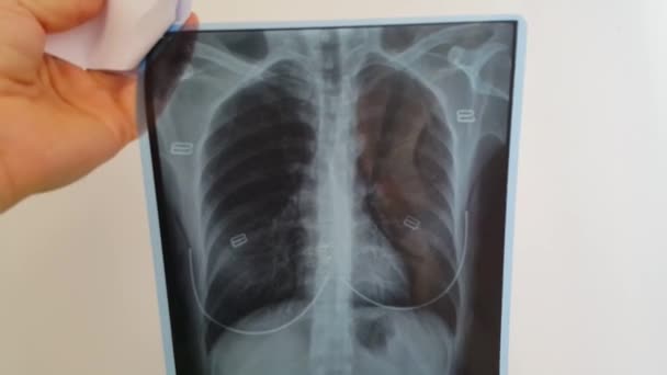 Ein Arzt untersucht den Röntgenfilm der Lungen und des Herzens einer Frau - Filmmaterial, Video