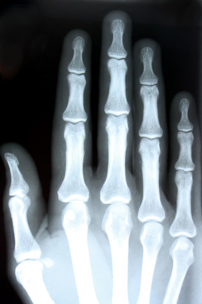 Radiografía de una mano
 - Foto, Imagen