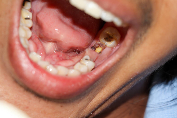 gaatjes en gebroken tanden zijn pijnlijk - Foto, afbeelding