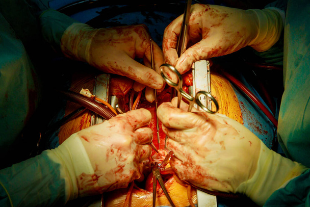 Patient während einer Herzoperation im Krankenhaus im Operationssaal - Foto, Bild