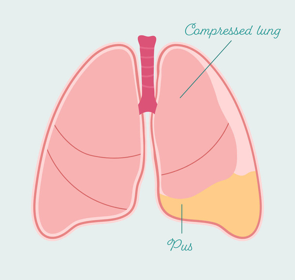Pyothorax ihmisen keuhkoissa. Keuhkopussin empyema, kerääminen mätä keuhkopussin tilaa - vektori anatominen suunnitelma - Vektori, kuva