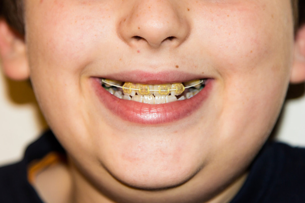 frenos y dientes blancos del niño sonriente
 - Foto, Imagen