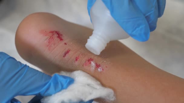 heel of an injured young child. abrasion on a persons leg, disinfection of wound. provision of first medical aid. traumatologists office, osomor of a patient with minor trauma. treatment and help - Footage, Video