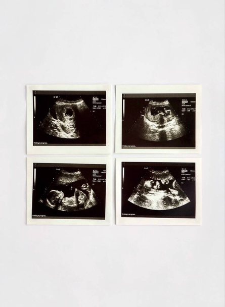 Raskaana olevan naisen ultraäänikuvat hedelmöityksestä raskauden kolmanteen kolmannekseen - Valokuva, kuva