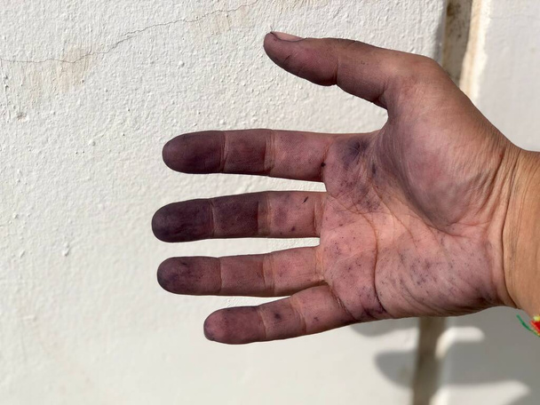 Μαύρα χέρια προκαλούνται από χημική έκθεση - Φωτογραφία, εικόνα