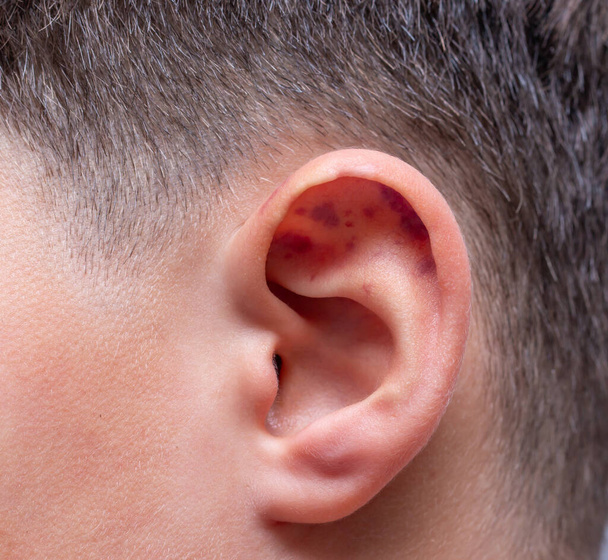 piccoli lividi sull'orecchio - Foto, immagini