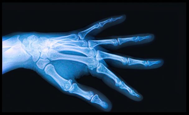 Xray of Hand and fingers - Photo, Image