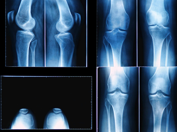 Radiografia del ginocchio
 - Foto, immagini