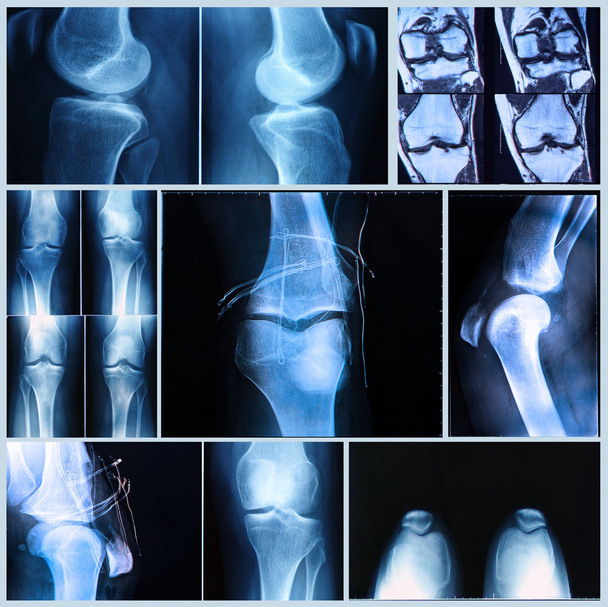 Exame médico do joelho: raio-X e ressonância magnética
 - Foto, Imagem