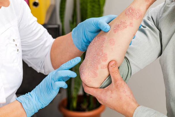 Un dermatólogo que usa guantes examina la piel de un paciente enfermo. Examen y diagnóstico de enfermedades de la piel-alergias, psoriasis, eczema, dermatitis. - Foto, imagen