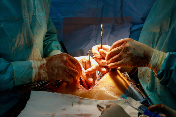 Tým chirurgů v nemocničním bypassu věnčité tepny pro operaci srdce - Fotografie, Obrázek