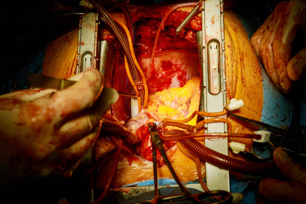 Lekarz kardiochirurg operacja operacja serca interwencja zastąpić zastawkę otwartą pępowiny operacja minimalnie inwazyjna - Zdjęcie, obraz