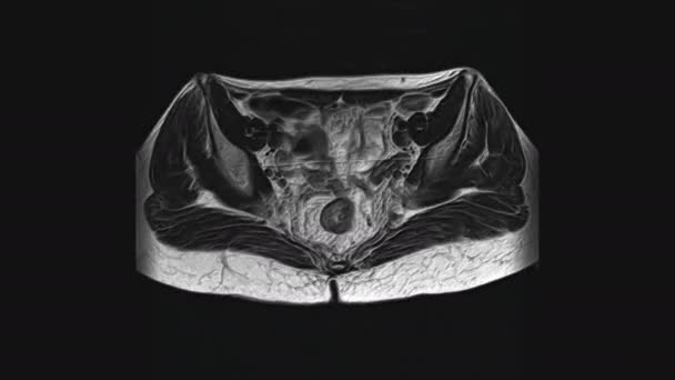 IRM volumineuse des organes pelviens féminins, cavité abdominale, tractus gastro-intestinal et vessie - Séquence, vidéo